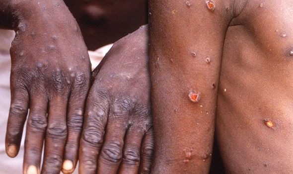Sud-Kivu : en espace de six mois, 239 cas de Monkey pox dont 3 décès signalés à Mwenga et Bukavu